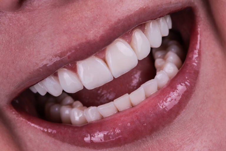 Detalle ampliado de textura y pulido en carillas de composite renovadas