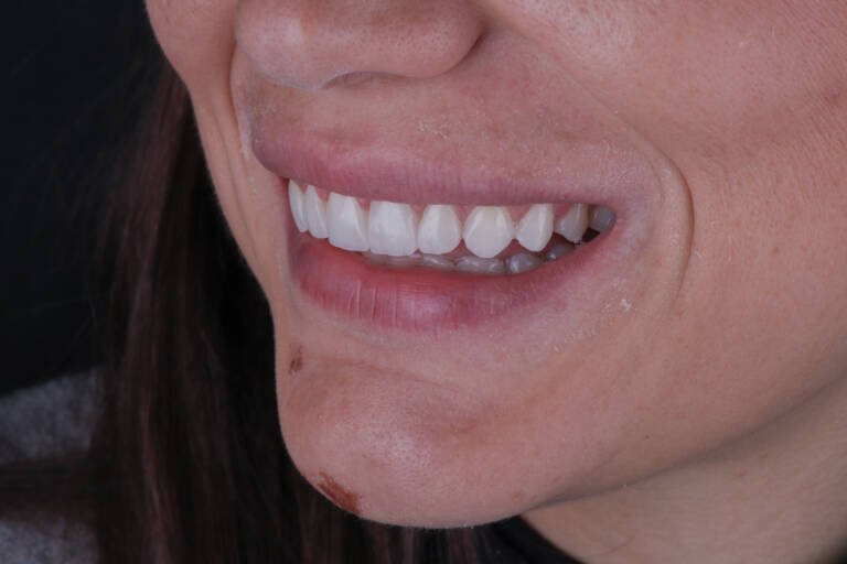 Vista intraoral lateral izquierda tras diseño de sonrisa con carillas de composite