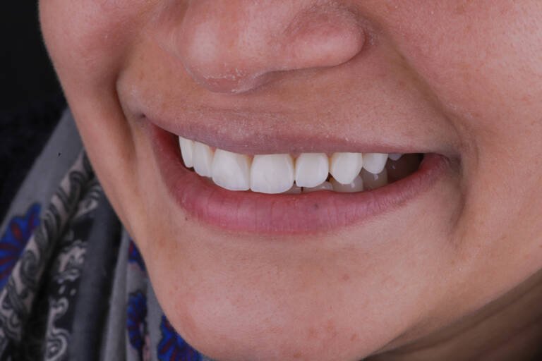 Vista intraoral lateral izquierda después de carillas de composite en sector anterior