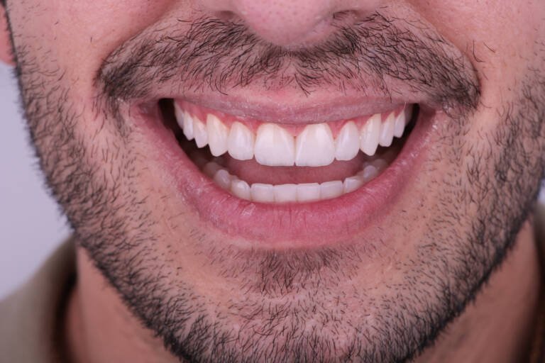 Vista intraoral frontal tras aumento de longitud con carillas de composite en incisivos superiores