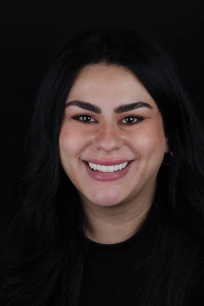 Retrato de mujer joven tras diseño de sonrisa con carillas de composite mínimamente invasivas en Valencia