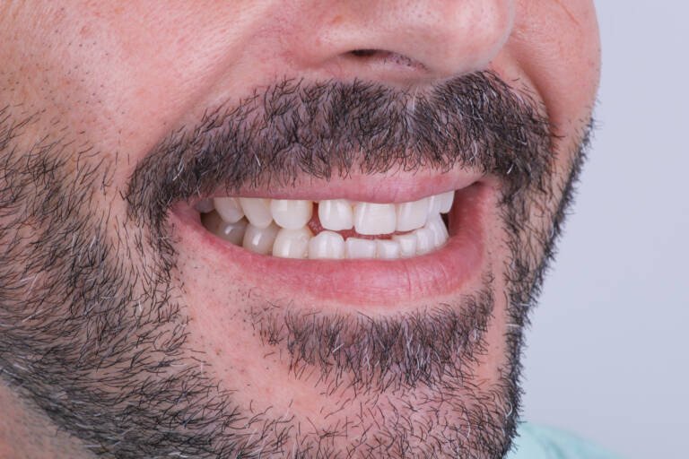 Vista intraoral lateral derecha antes de tratamiento estético dental en hombre