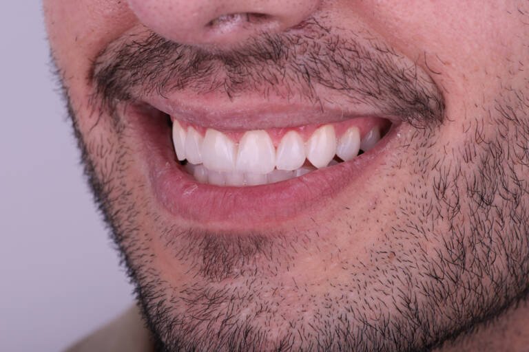 Vista intraoral lateral izquierda tras alargamiento dental con carillas de composite