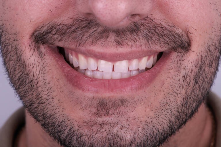 Vista intraoral frontal con incisivos superiores cortos tras ortodoncia previa