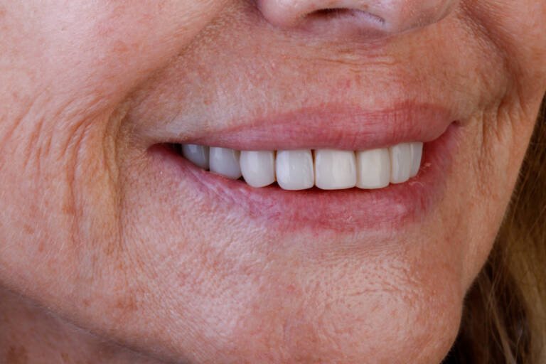 Vista intraoral lateral derecha antes de tratamiento con carillas de composite