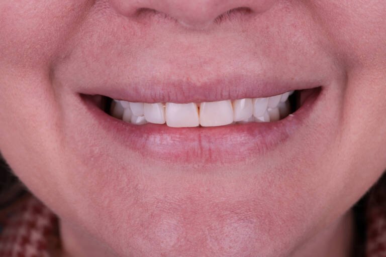 Vista intraoral frontal con carillas de composite tras más de 10 años de uso