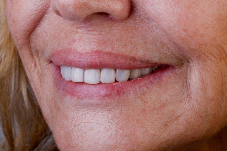 Vista intraoral lateral izquierda antes de tratamiento estético dental