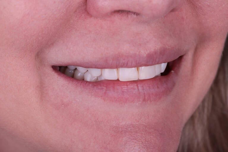 Vista intraoral lateral derecha con carillas de composite antiguas antes del recambio