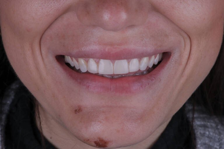 Vista intraoral frontal antes de tratamiento con carillas de composite en sector anterior