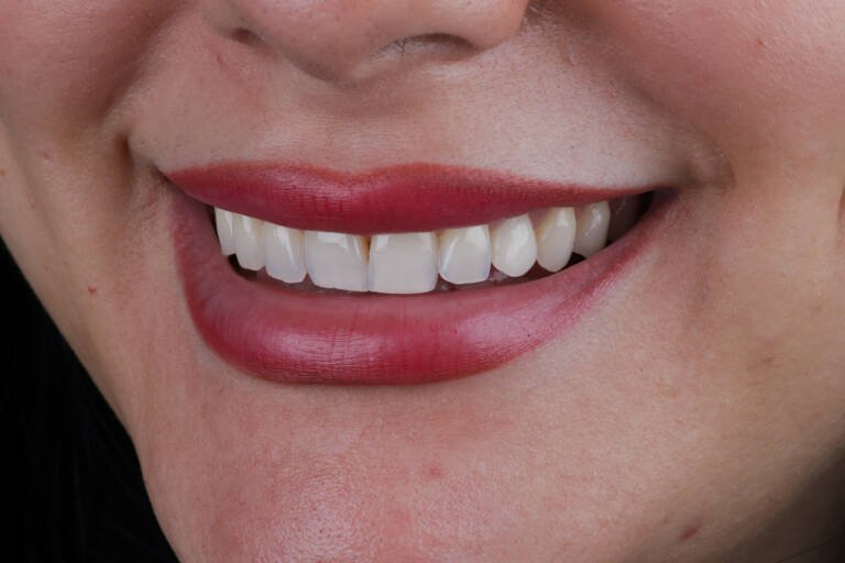 Vista intraoral lateral izquierda antes de diseño de sonrisa natural