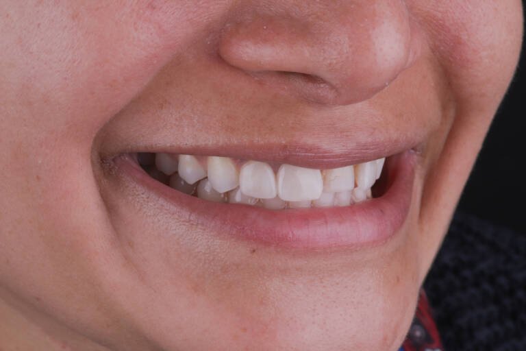 Vista intraoral lateral derecha antes de recambio de carillas de cerámica