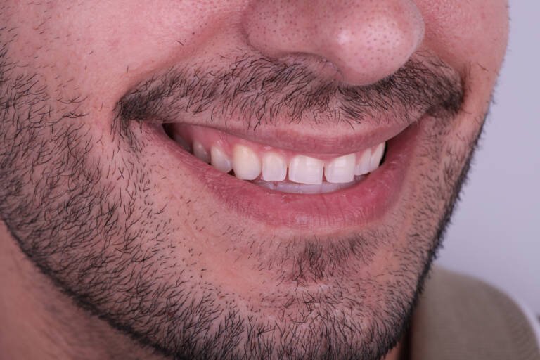 Vista lateral derecha de dientes anteriores cortos antes de tratamiento estético