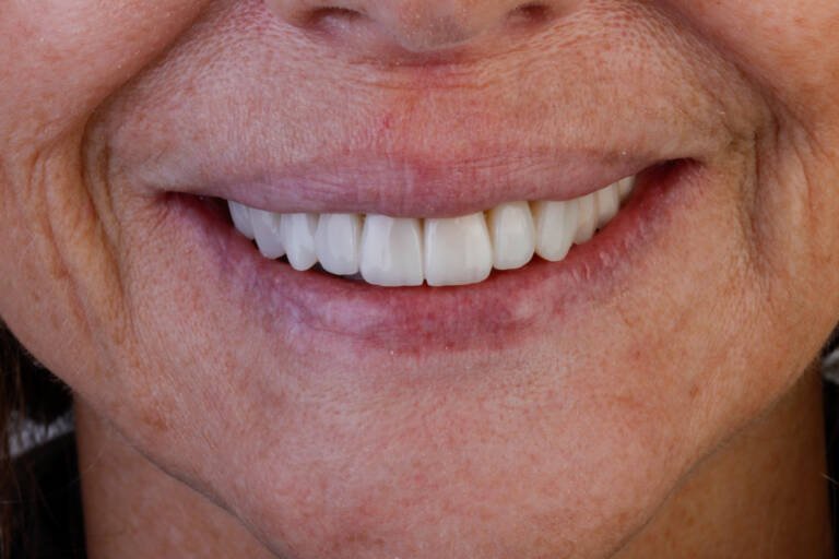 Vista intraoral frontal después de diseño de sonrisa con carillas de composite en sector anterior superior