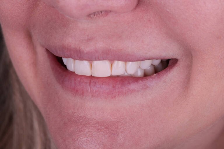 Vista intraoral lateral izquierda con carillas de composite tras años de uso