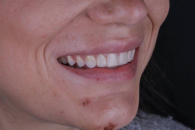 Vista intraoral lateral derecha antes de diseño de sonrisa con composite