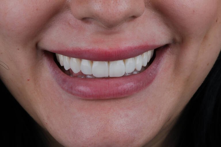 Vista intraoral frontal después de carillas de composite sin tallado en sector anterior