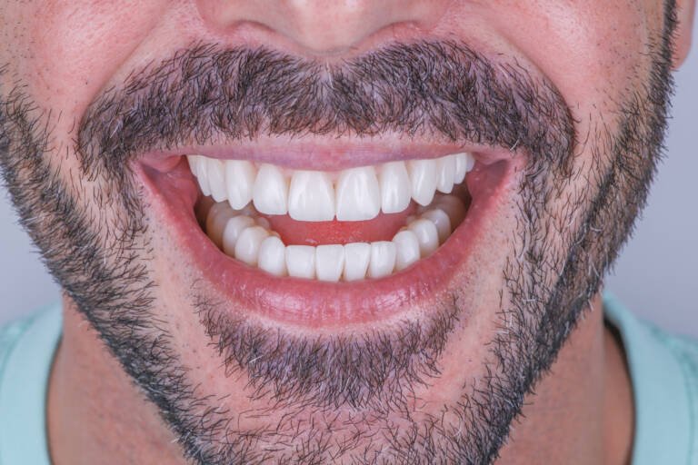 Vista intraoral frontal tras diseño de sonrisa con carillas de composite en paciente masculino