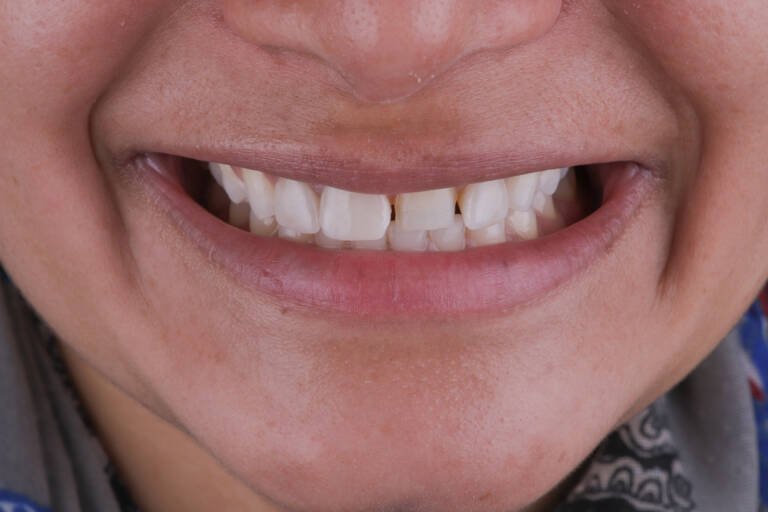 Vista intraoral frontal antes de recambio de carillas de cerámica por carillas de composite