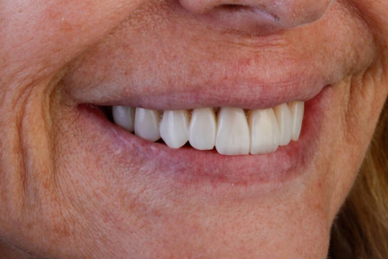 Vista intraoral lateral derecha después de diseño de sonrisa con carillas de composite