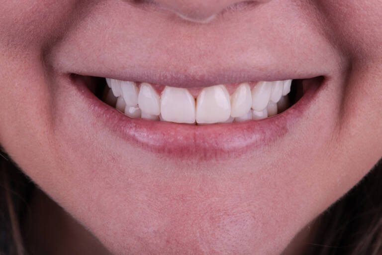 Vista intraoral frontal tras recambio y actualización de carillas de composite