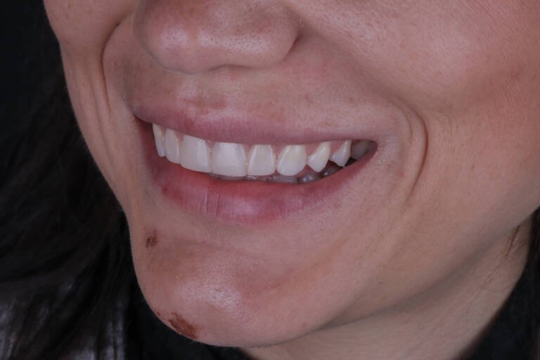 Vista intraoral lateral izquierda antes del tratamiento estético con composite