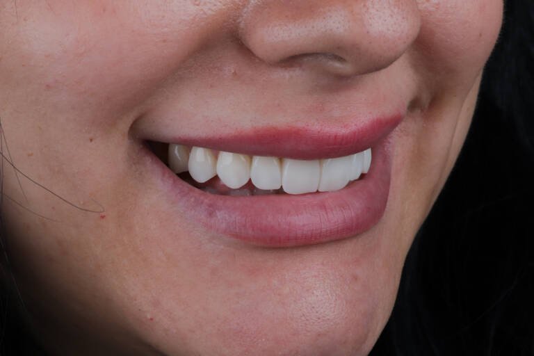 Vista intraoral lateral derecha tras carillas de composite conservadoras