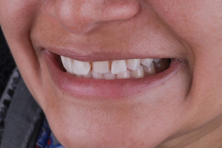 Vista intraoral lateral izquierda antes de sustitución de carillas cerámicas