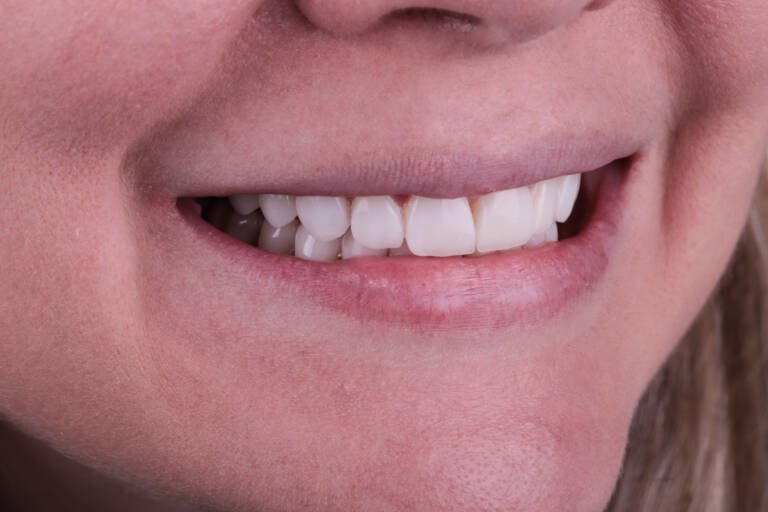 Vista intraoral lateral derecha tras renovación de carillas de composite