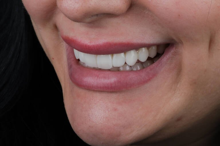 Vista intraoral lateral izquierda tras carillas de composite sin tallado dental