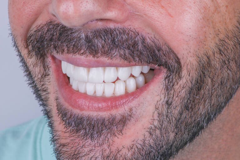 Vista intraoral lateral izquierda tras diseño de sonrisa natural en hombre