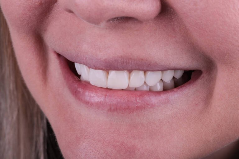 Vista intraoral lateral izquierda tras renovación de carillas de composite