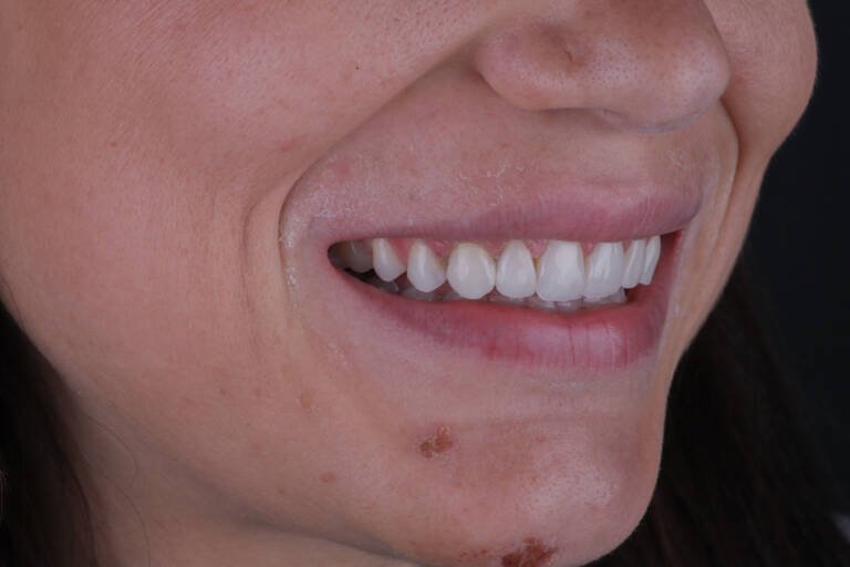 Vista intraoral lateral derecha tras carillas de composite con acabado biomimético