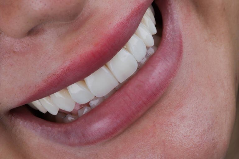 Detalle ampliado de acabado y textura superficial en carillas de composite