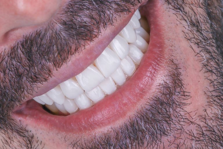 Detalle ampliado de textura y pulido en carillas de composite con acabado natural