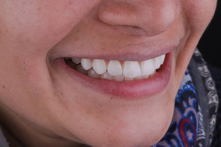 Vista intraoral lateral derecha después de tratamiento con carillas de composite