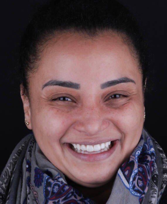 Retrato de mujer de 35 años tras recambio de carillas de cerámica por carillas de composite en diseño de sonrisa