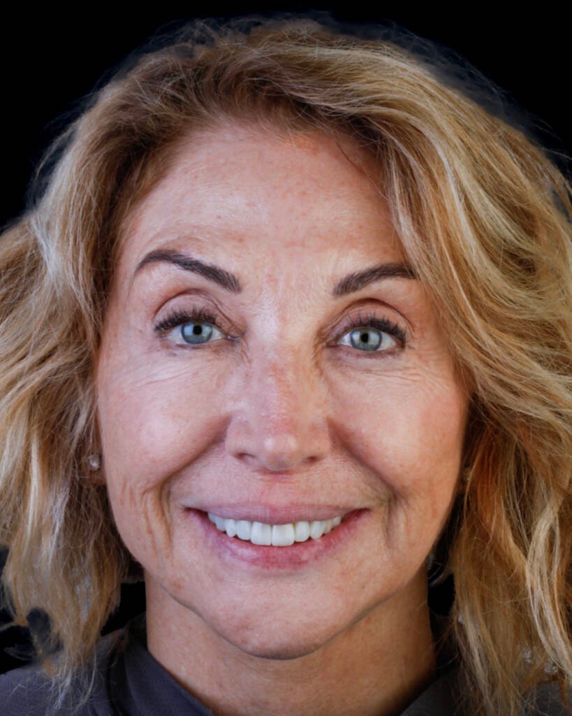 Retrato frontal de mujer de 60 años tras diseño de sonrisa con 10 carillas de composite, recambio completo de carillas previas