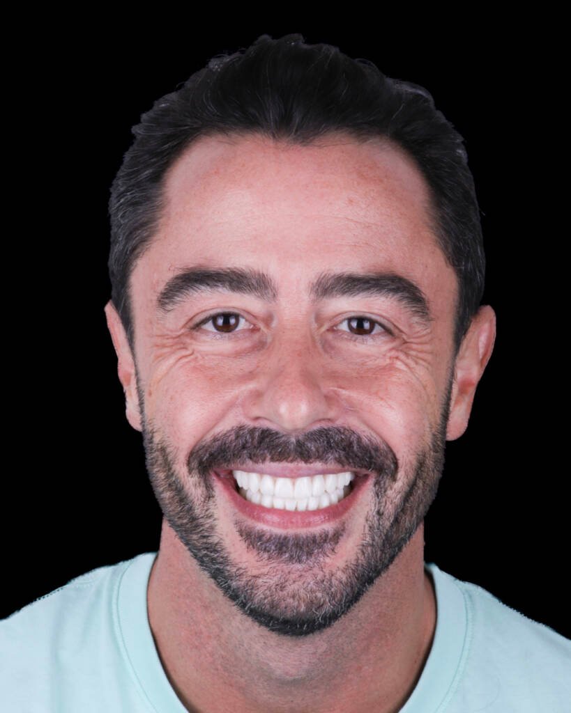 Retrato de hombre tras diseño de sonrisa con carillas de composite de resultado discreto y natural