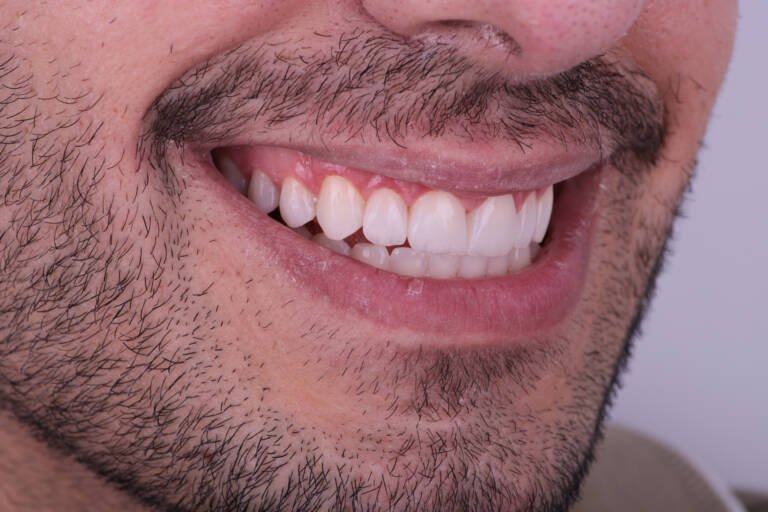 Vista lateral derecha tras alargamiento de incisivos con carillas de composite