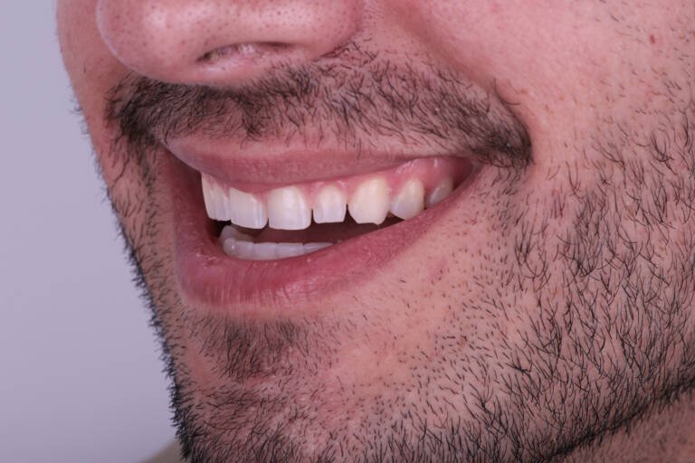 Vista intraoral lateral izquierda con incisivos de menor longitud antes del tratamiento