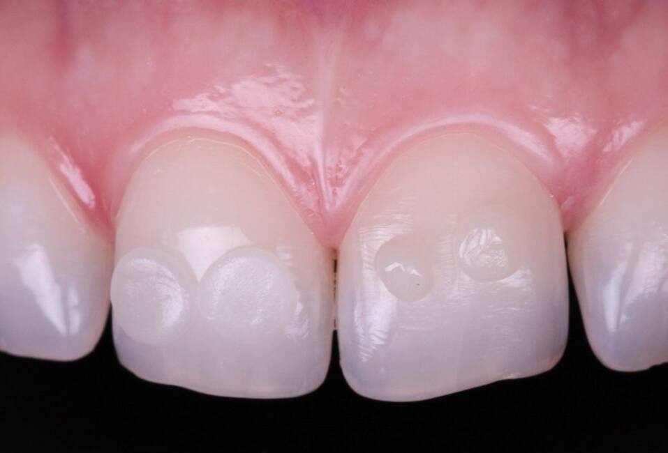Estratificación de carillas de composite capa a capa - técnica directa