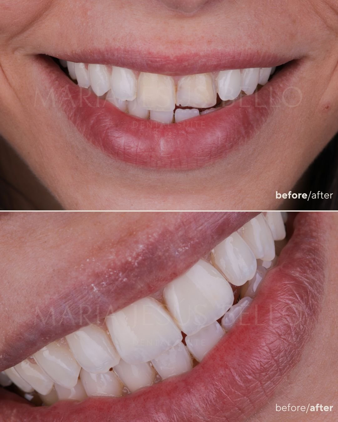 Resultado carillas composite - corrección de cambio de coloración post traumatismo Valencia"