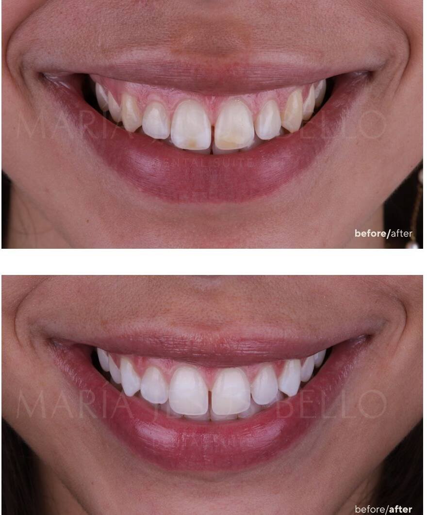 Fotografía de antes y después mostrando la sonrisa de una paciente donde se han eliminado las manchas blancas del esmalte mediante infiltración de resina, logrando un color uniforme y natural sin desgaste dental.