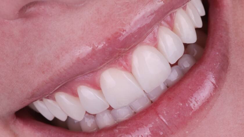 Resultado estético de carillas de composite estratificadas en dientes anteriores con aspecto natural y acabado premium