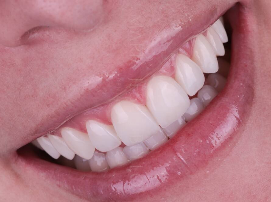 Resultado estético de carillas de composite estratificadas en dientes anteriores con aspecto natural y acabado premium
