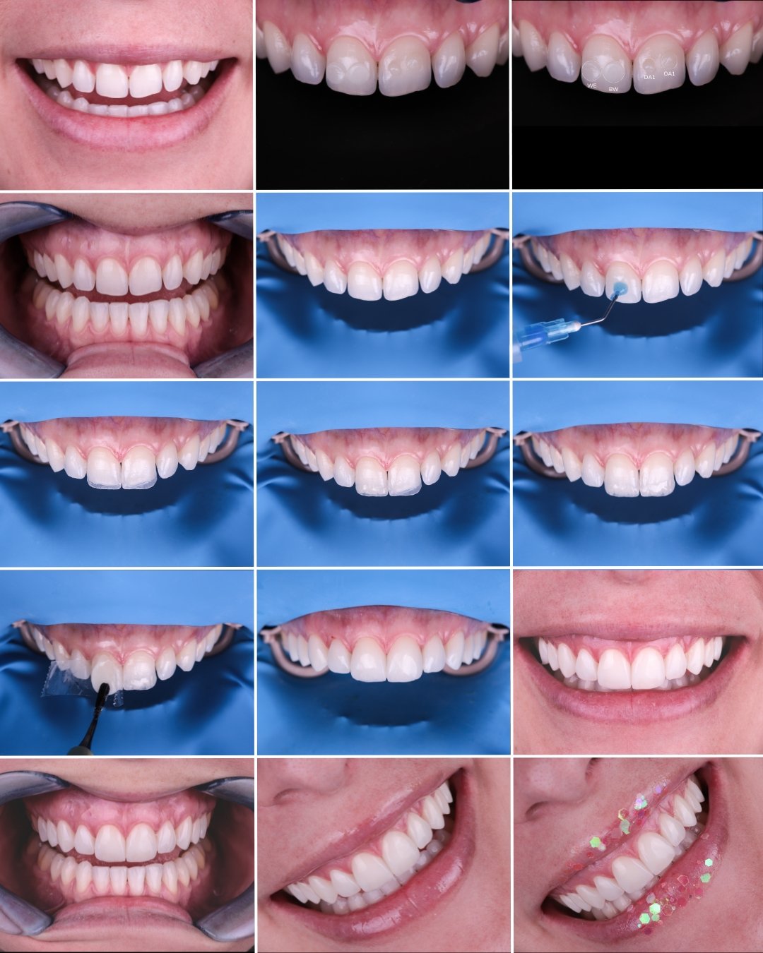 Técnica directa de carillas de composite sin tallado dental - procedimiento mínimamente invasivo
