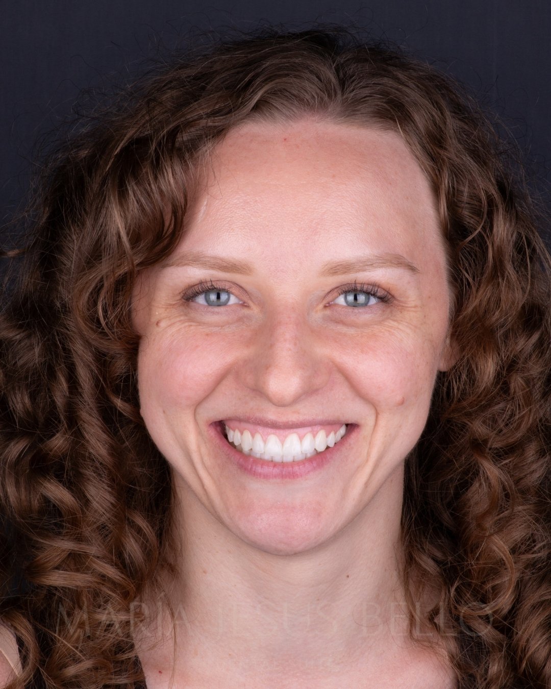 Resultado natural de carillas dentales en clínica de estética dental en Valencia - María Jesús Bello Dental Suite