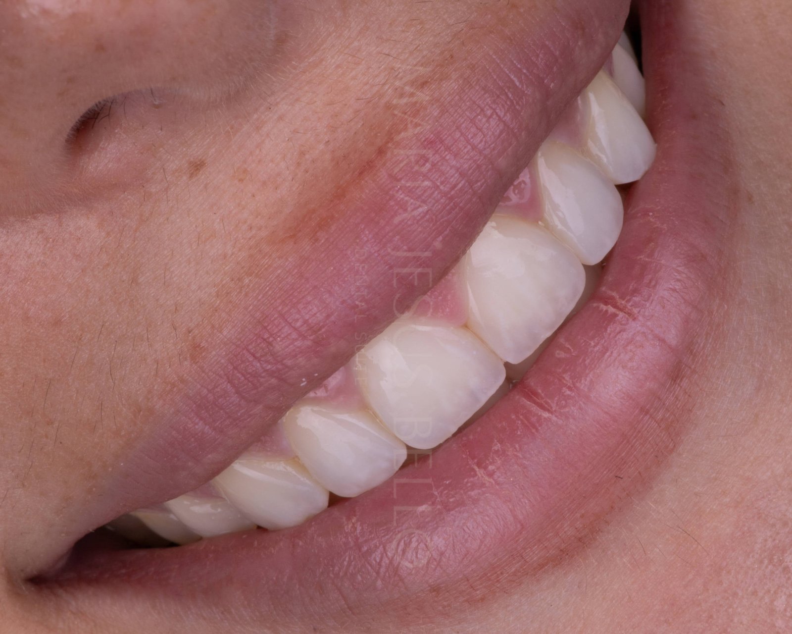 Comparativa carillas dentales composite o porcelana - resultado natural - Clínica María Jesús Bello Valencia